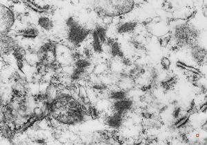 F,55y. | omentum - rhabdomyosarcoma F,55y. | omentum - rhabdomyosarcoma